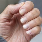 Quelle maladie fait blanchir les ongles ?