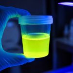 Urine fluorescent : comprendre les causes et implications médicales